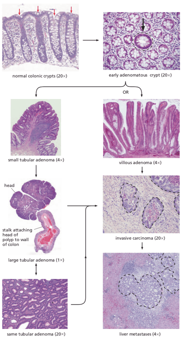 Histology stains reveal multistep progression of tumor formation.